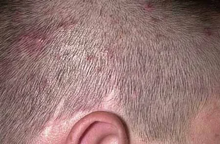 پوست دانه قرمز روی پوست سر