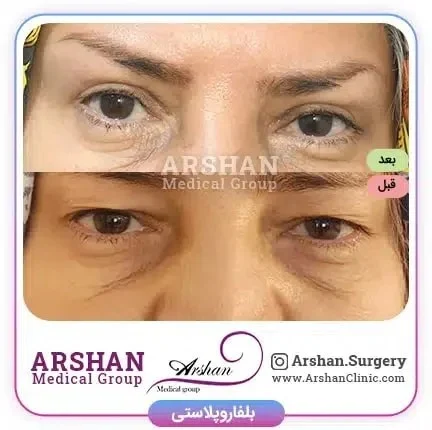 نتیجه نهایی عمل بلفاروپلاستی کی مشخص می شود؟