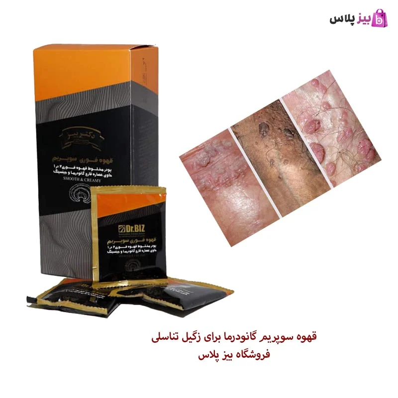 زگیل تناسلی انتقال زگیل تناسلی از طریق ژیلت