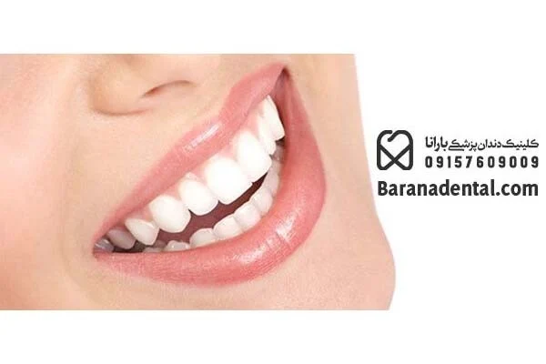 گوشی لمینت دندان خرگوشی