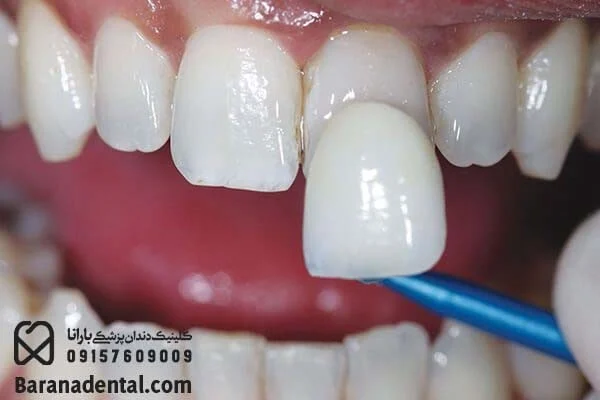 گوشی لمینت دندان خرگوشی