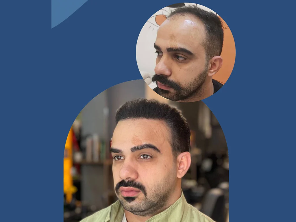 آیا کاشت مو با سلول‌های بنیادی جایگزین روش‌های سنتی می‌شود؟
