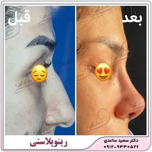 رینوپلاستی چه فرقی با عمل بینی دارد؟
